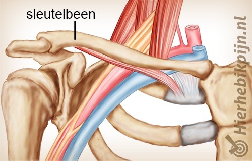 schouder arm hand tos thoracic outlet syndroom sleutelbeen