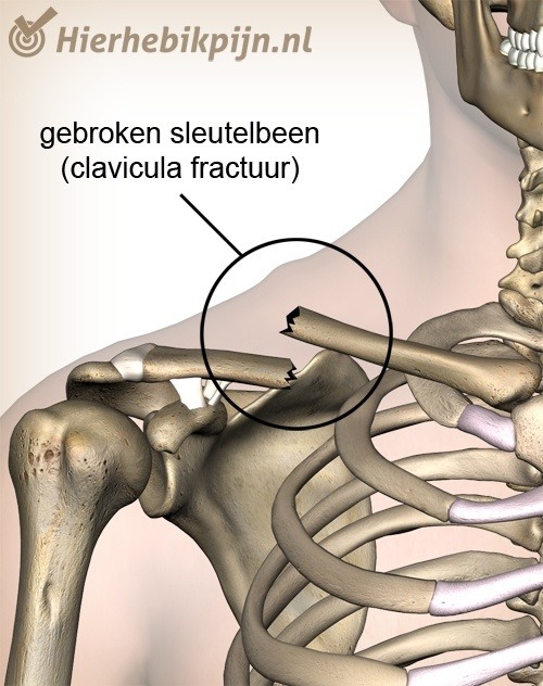 schouder clavicula fractuur gebroken sleutelbeen breuk