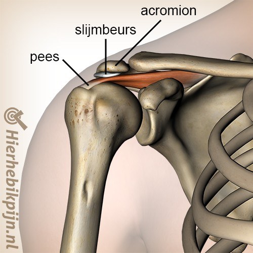 schouder impingement slijmbeurs bursa supraspinatus