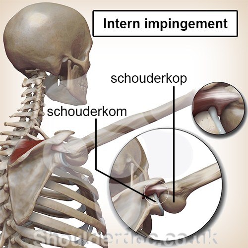 schouder intern impingement schouderkop schouderkom inklemming