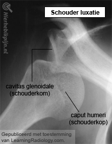 schouder rontgen luxatie