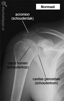 schouder rontgen normaal