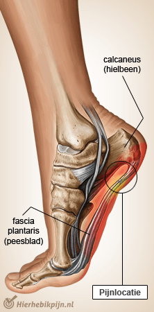 voet fasciitis plantaris apaneurosis hielspoor