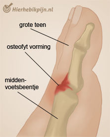 voet hallux rigidus osteofyt vorming