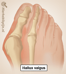 voet hallux valgus anatomie
