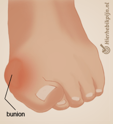 voet hallux valgus bunion