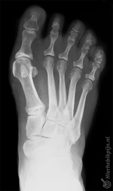 voet hallux valgus rontgen foto