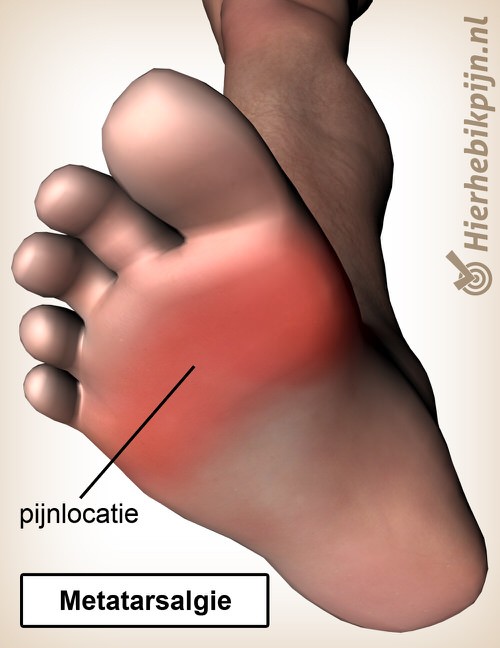 Co je to Metatarsalgie?