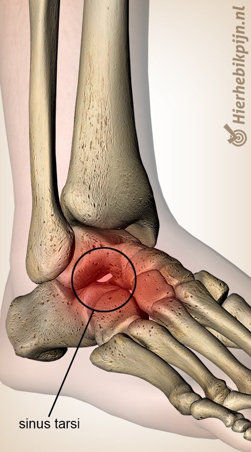 voet sinus tarsi syndroom talus calcaneus