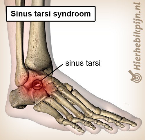 voet sinus tarsi syndroom tunnel