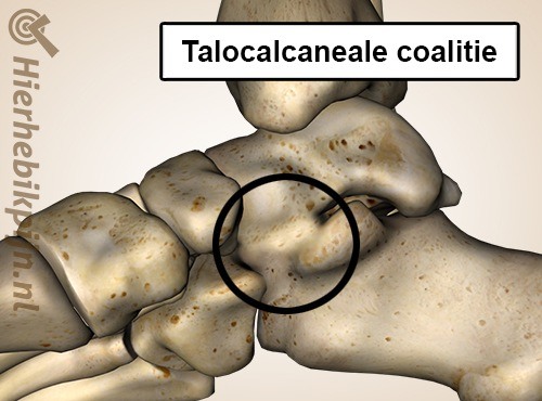 voet talocalcaneale coalitie