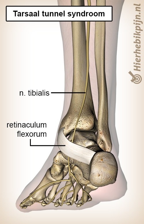 voet tarsaal tunnel syndroom nervus tibialis posterior retinaculum flexorum