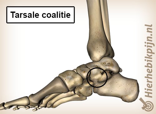 voet tarsale coalitie mediaal binnenkant