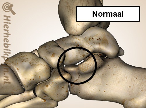 voet tarsale coalitie talocalcaneale normaal