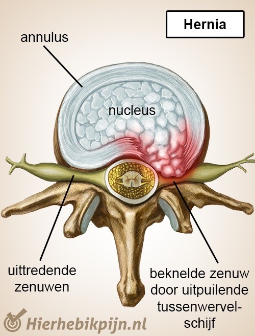 wervelkolom wervel tussenwervelschijf hernia zenuwen