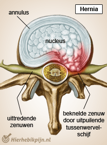 wervelkolom wervel tussenwervelschijf hernia zenuwen