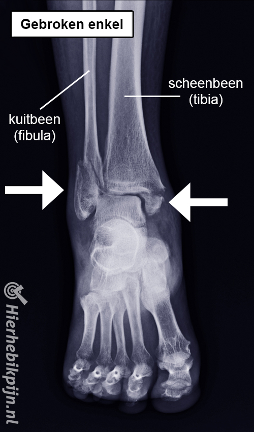 gebroken enkel rontgenfoto enkelfractuur