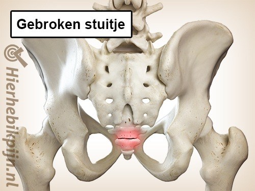 gebroken stuitje coccygis fractuur staartbeen breuk