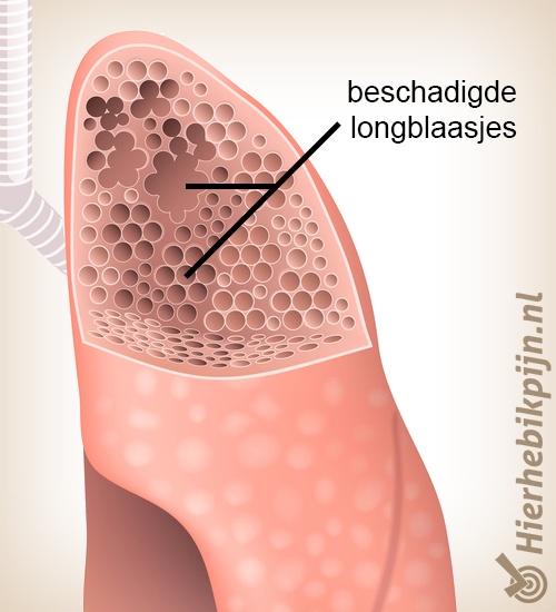 longen longemfyseem emfyseem beschadigde longblaasjes stuk kapot