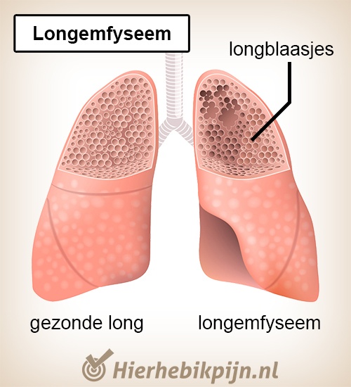 longen longemfyseem emfyseem longblaasjes gezond beschadigd