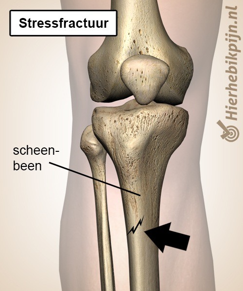 onderbeen scheenbeen stressfractuur tibia