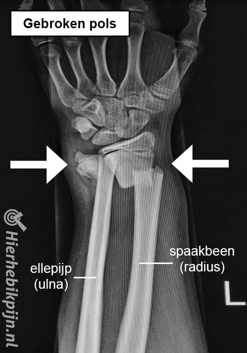 rontgenfoto arm gebroken pols fractuur botbreuk spaakbeen ellepijp radius ulna