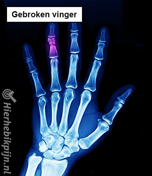 rontgenfoto gebroken vinger fractuur