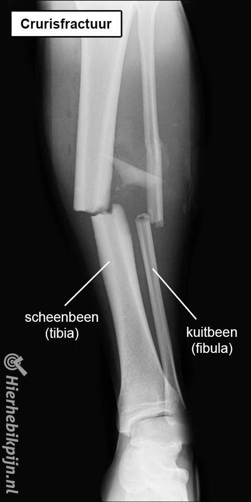 rontgenfoto onderbeen crurisfractuur gebroken onderbeen tibia fibula