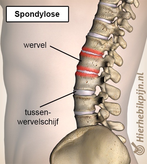 rug spondylose spondylosis wervelkolom wervel tussenwervelschijf wervel discus slijtage artrose 2