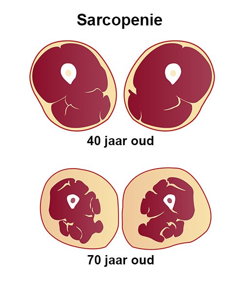 sarcopenie