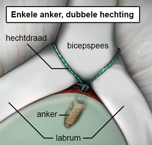 schouder slap laesie operatie type ii anker hechting labrum bicepspees