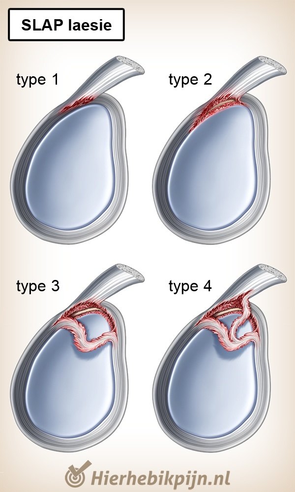 schouder slap laesie types 1 2 3 4