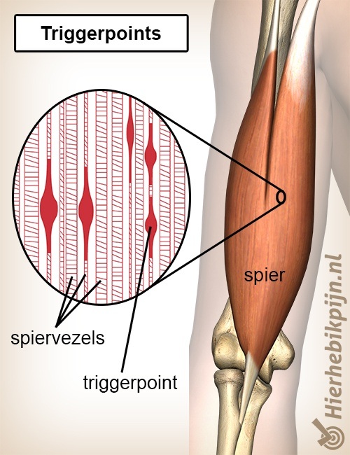 triggerpoint spier myofasciale triggerpoints spiervezels