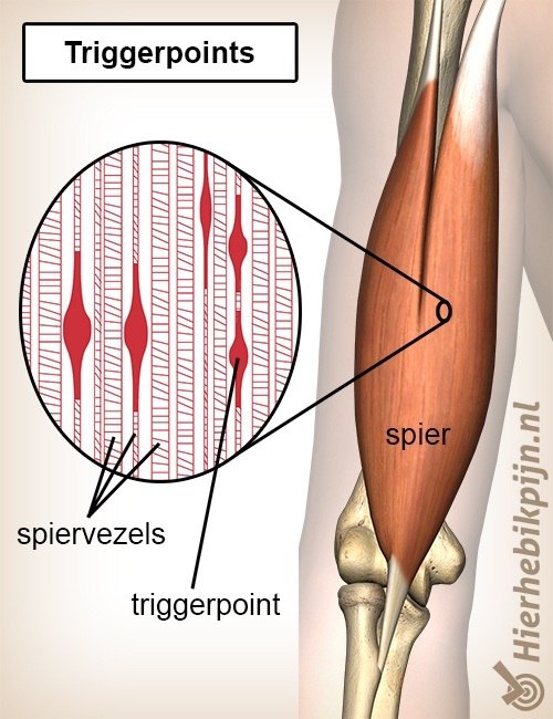 Pygmalion koper Parameters Triggerpoints | Anatomie | Hier Heb Ik Pijn