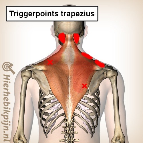 triggerpoints spier trapezius achterkant