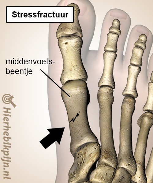 voet stressfractuur middenvoet middenvoetsbeentje metatarsus