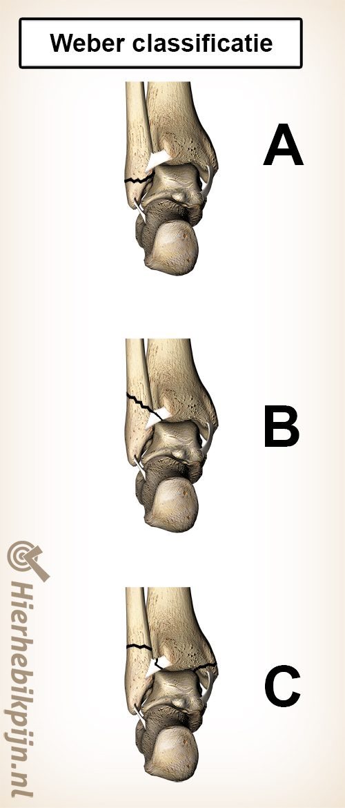 weber classificatie kuitbeen breuk fractuur fibula