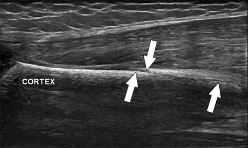 botbreuk-echografie-cortex.jpg