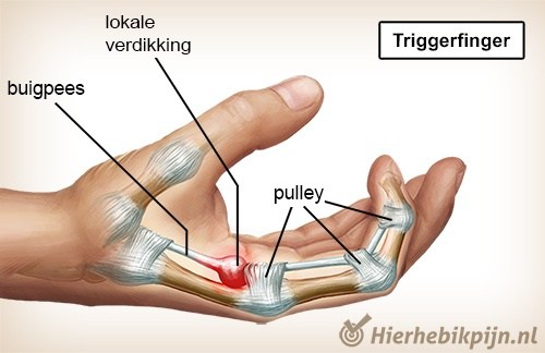 hand-triggerfinger-3.jpg