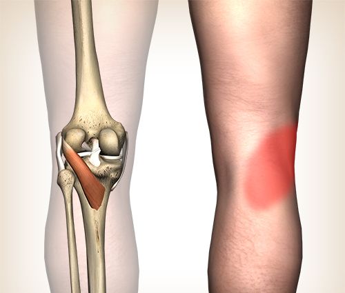 Online oefenprogramma Jumper`s knee