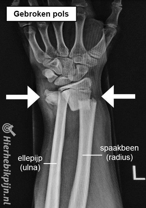 Arm gebroken pols fractuur botbreuk spaakbeen ellepijp radius ulna