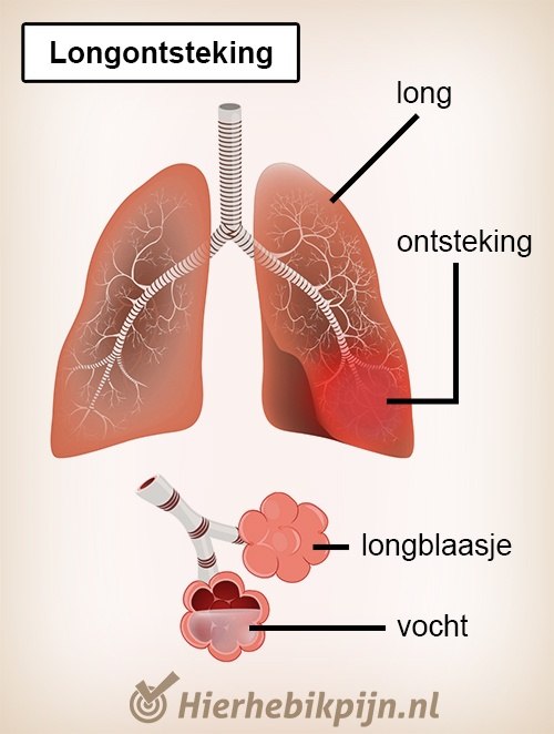 Borst longen longontsteking alveoli longblaasjes vocht