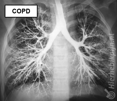 Copd longen rontgenfoto