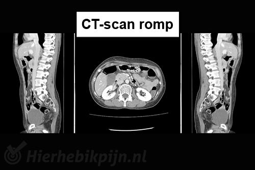 Ct romp