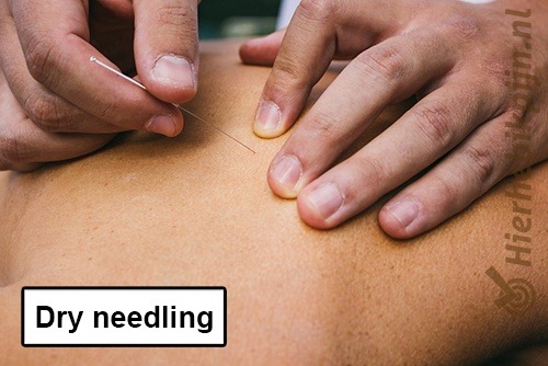 Dry needling triggerpoint schouder