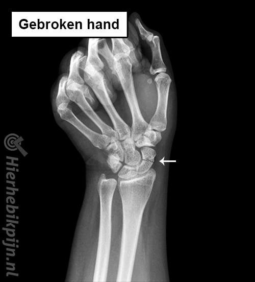 Gebroken hand carpus fractuur handwortelbeentjes rontgenfoto