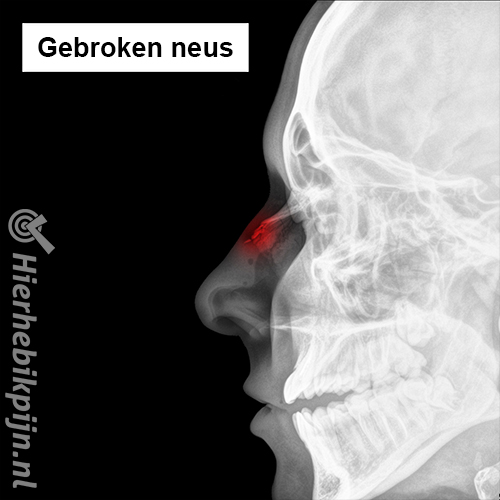 Gebroken neus fractuur rontgenfoto