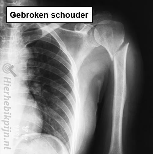 Gebroken schouder humerus fractuur bovenarm rontgenfoto