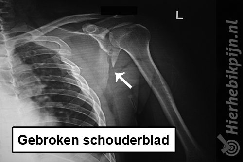Gebroken schouderblad scapula fractuur schouder rontgenfoto