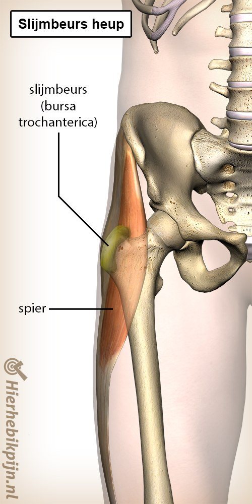 Heup slijmbeurs ontsteking bursa bursitis trochanterica